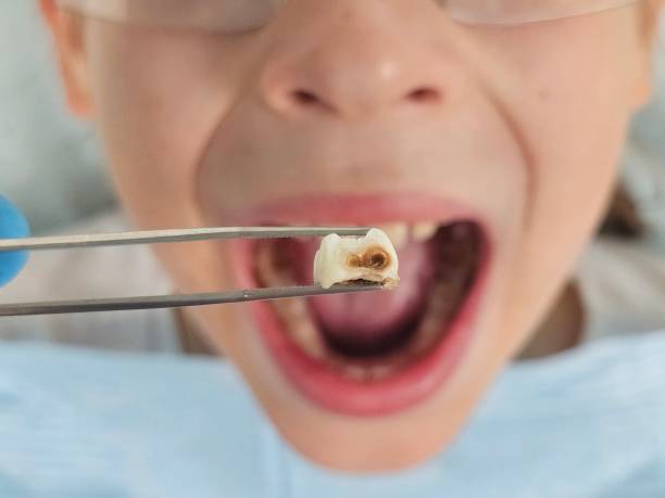 Best Emergency Treatment for Dental Infections or Abscesses in Waverly, MN